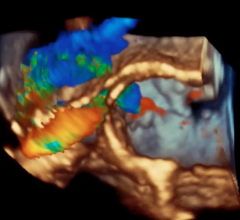 An example of one of the latest echocardiography image processing technologies, GE's Vmax.