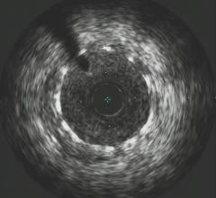 Philips Healthcare, Volcano IVUS showing an implanted stent. IVUS might offer an alternative to contrast angiography in patients with acute kidney disease (AKD).