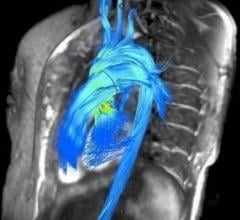 Arterys, 4-D Flow software, cardiac MRI, RSNA 2016