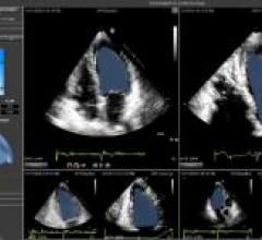 Epsilon Imaging, EchoInsight, ASE 2015, cardiac ultrasound image analysis