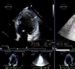 Epsilon Imaging Echo insight (echoinsight) strain imaging on cardiac ultrasound