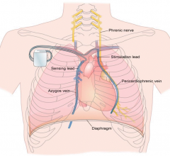 The Respicardia Remede System is a pacemaker-like device designed to improve cardiovascular health by restoring natural breathing during sleep in patients with Central sleep apnea.
