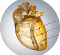 Bioventrix, Revivent-TC System, heart failure, first-in-man procedure