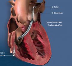 Illustration showing the venous implantation route and where the inlet and outflow ports are when the Abiomed Impella RP is placed in the right side of the heart. The  Impella RP catheter is used for right heart hemodynamic support. 