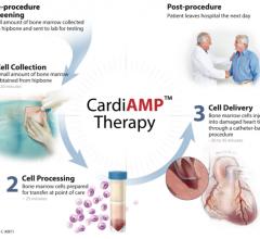 The BioCardia cardiac stem cell CardiAMP trial is a Phase III study looking at the efficacy of using stem cells to improve heart function in heart failure patients. It is the first trial for this technology to reach Phase III trial.