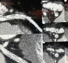 The use of metal artifact reduction software on this CCTA (CTA) cardiac CT from an Canon, Toshiba, Aquilion Precision, allows clear visualization inside a coronary stent. The 0.25 mm high-resolution reconstruction also helps delineate the various components of plaque.