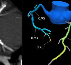 A comparison of CT image of heavily calcified coronary arteries that appear to present a significant hemodynamic blockages and the correspending FFR-CT showing the patient had adequate blood flow and does not need a diagnostic angiogram or intervention.