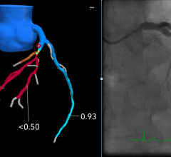 An example of FFR-CT imaging from Beaumont Hospital in Royal Oak, Mich. The left image shows a 3D generated image of the coronary tree from a CT scan evaluated with computational fluid dynamics to determine the FFR numbers. It shows a severe restriction of the left main artery which requires a stent to revacularize. The image on the right is a comparison with the invasive angiogram from the cath lab prior to stenting. 
