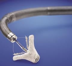 FDA Approves MitraClip for Use in Heart Failure Patients With Functional Mitral Regurgitation