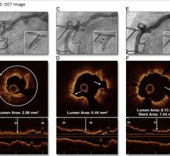 Angiography shows a stenotic lesion in the mid right coronary artery, undilatable by standard high-pressure balloon angioplasty (inset, arrowheads). (B) Optical coherence tomography (OCT) cross-sectional (top) and longitudinal (bottom) images acquired before IVL and coregistered to the OCT lens (arrow in A) demonstrate severe near-circumferential calcification in the area of the stenosis. (C) Angiography demonstrates improvement in the area of stenosis after IVL lithoplasty.