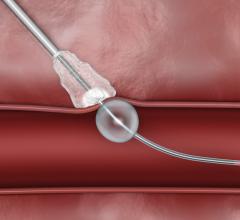 The bioresorbable Cordis Mynx Grip vascular closure device seals arteriotomies without use of permanent hardware.