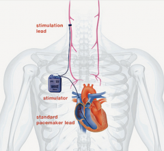 cardiofit, vagus nerve stimulation for heart failure, bio control medical