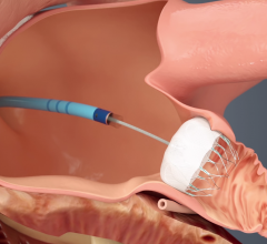 Illustration of the Watchman transcatheter left atrial appendage (LAA) occluder being  deployed into the LAA. FDA is concerned about higher rates of LAA occlusion complications in women compared to men, prompting the FDA to send a letter to providers warning them on possible poor outcomes.