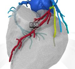 FFR-CT imaging developed by HeartFlow offers coronary flow data noninvasively. Clinical data so far shows close correlation with invasive catheter-based FFR measurements. The technology helps pinpoint ischemic culprit lesions and determine the severity of coronary stenosis.
