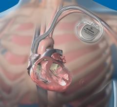 Medtronic's Attain Performa Quadripolar Lead and VivaQuad XT CRT-D system. Quadripolar leads enable more programming options to enable better patient care with this implantable cardioverter defibillator (ICD)..