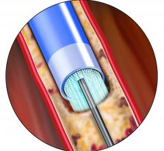Spectranetics Peripheral Artery Disease Laser Atherectomy 