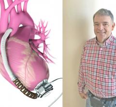 James Ward, LVAD surgery, left ventricular assist device, UAB, University of Alabama at Birmingham