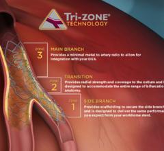 Tryton Side Branch Stent EXTENDED Access Registry