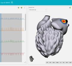 Vektor Medical has announced positive results from its “Vektor vMap Clinical Validation Study” evaluating the accuracy of cardiac mapping with vMap.