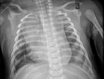 Chest X-ray of a  2-month-old infant diagnosed with COVID-19 showing an enlarged heart, bibasilar opacities caused by collapse of the lower sections of lungs, and right upper lobe atelectasis (lung collapse). Find more information and figures on this patient case.