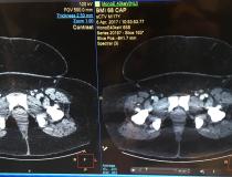 This is an example of how the newer CT scanner technologies can help improve image quality even in difficult to image patients. This example shows a very obese patient with a BMI of 68 scanned on a Philips IQon spectral CT scanner. The system used a combination of iterative and model based image reconstruction and spectral imaging to enable diagnostic quality imaging.  #SCCT2019 #SCCT