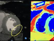 Example from Philips spectral CT system showing the conventional cardiac CT and a spectral image that can better enhance iodine contrast to reveal an area of ischemia or infarct in the myocardium.