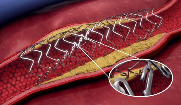 Elixir Medical Receives FDA Breakthrough Device Designation for DynamX BTK System for Below-The-Knee Arterial Disease - Vimarsana News