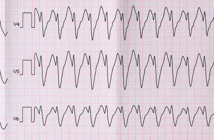 ACC, AHA Issue Updated Performance Measures for Adults with Atrial Fibrillation or Atrial Flutter - Vimarsana News