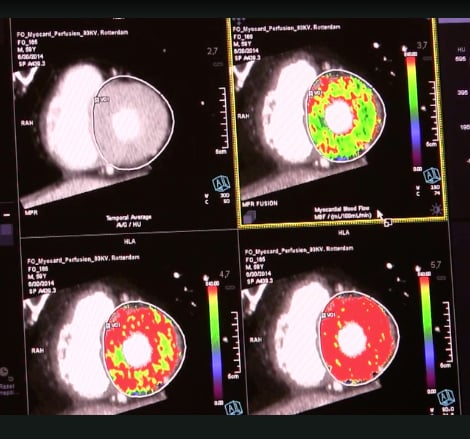 An example of a cardiac computed tomography angiography (CTA) perfusion exam showing iodine contrast mapping in the myocardium, which is used as a surrogate for blood perfusion.