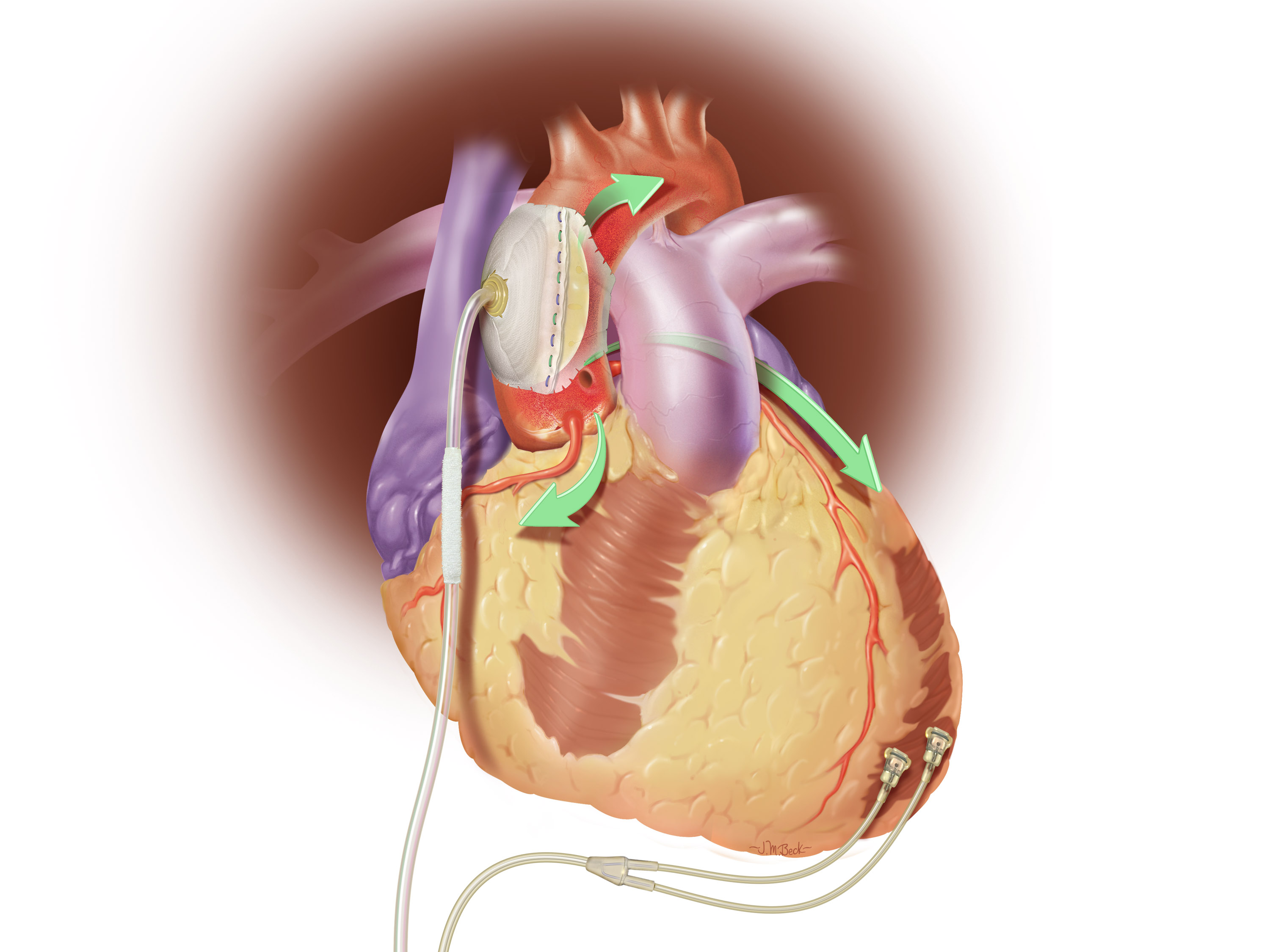 Sunshine Heart Borrows 2 Million For C Pulse Heart Failure Device Trial Daic