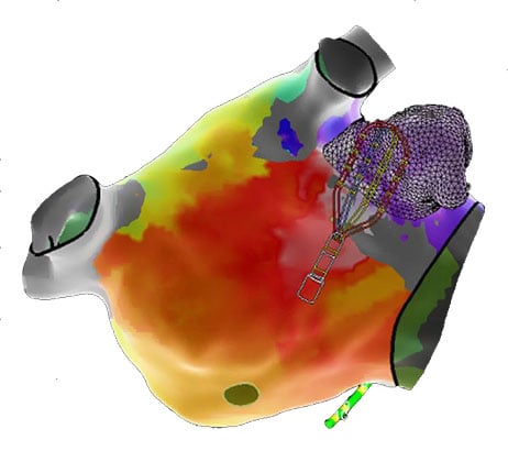 FDA Clears New Cardiac Mapping System to Improve How Doctors Treat Abnormal Heart Rhythms - Vimarsana News