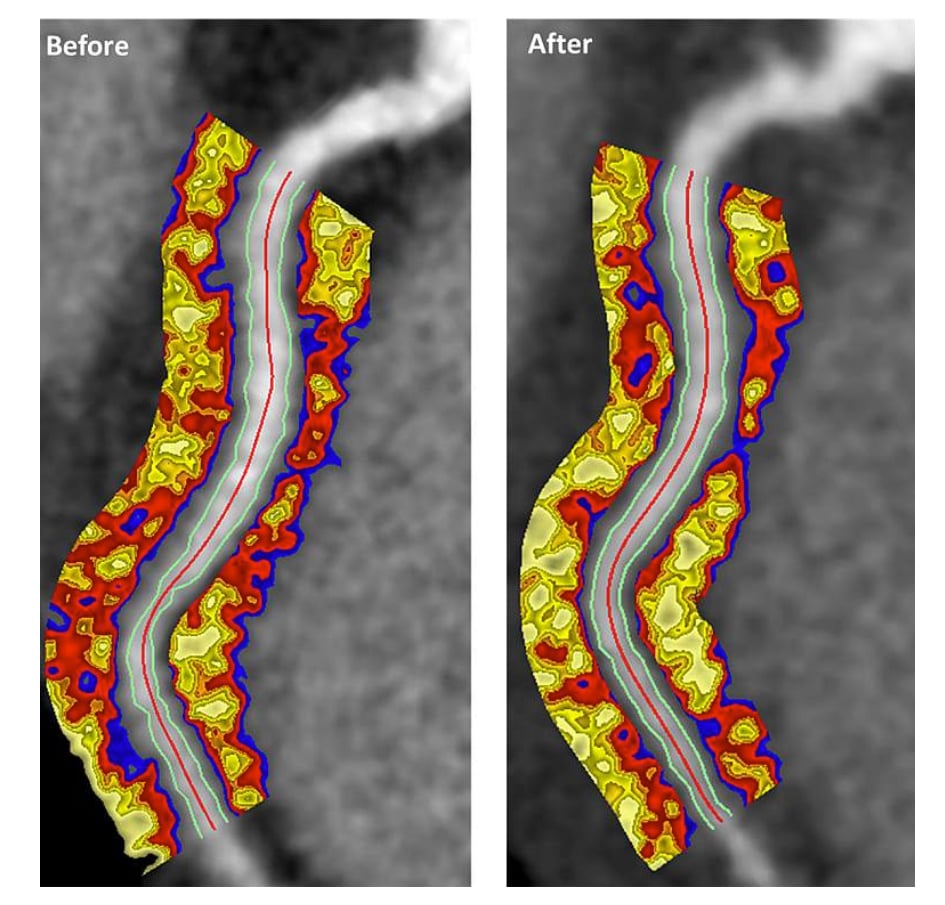 psoriasis coronary artery disease