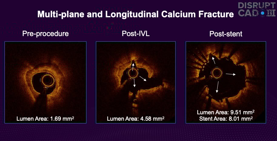 Calcified Coronary Artery Disease Icd 10