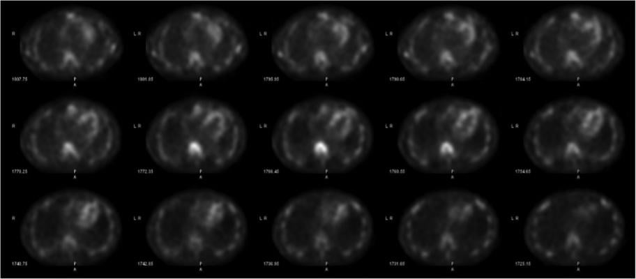 Amyloid pyrophosphate imaging is not new, but now there is renewed interest because of the new FDA-cleared drugs available to treat amyloidosis. #ASNC #ASNC19 