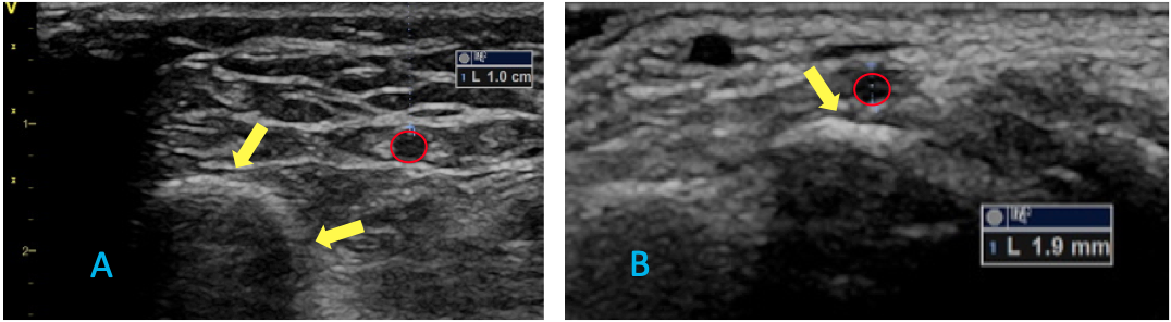 Distal Radial Access. Figure 1. Puncturing at the distal site offers advantages in terms of anatomy, as the radius bone is oblique to the radial artery (left – yellow arrows), whereas the carpal bone is horizontal to the radial artery at the wrist (right – white arrow). #Radialfirst