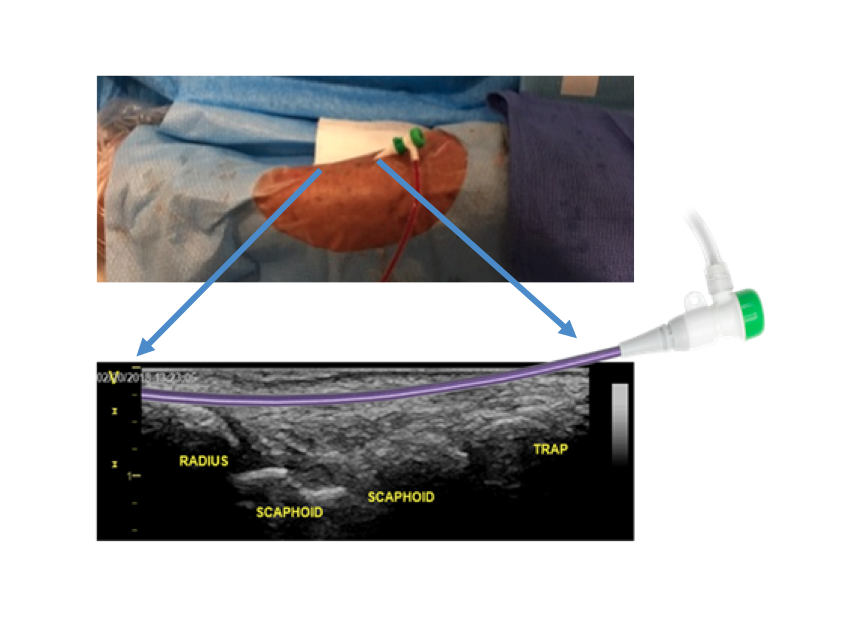 #Radialfirst Figure 2. Insertion of the sheath in the distal artery follows a curvilinear trajectory through the carpal bones.