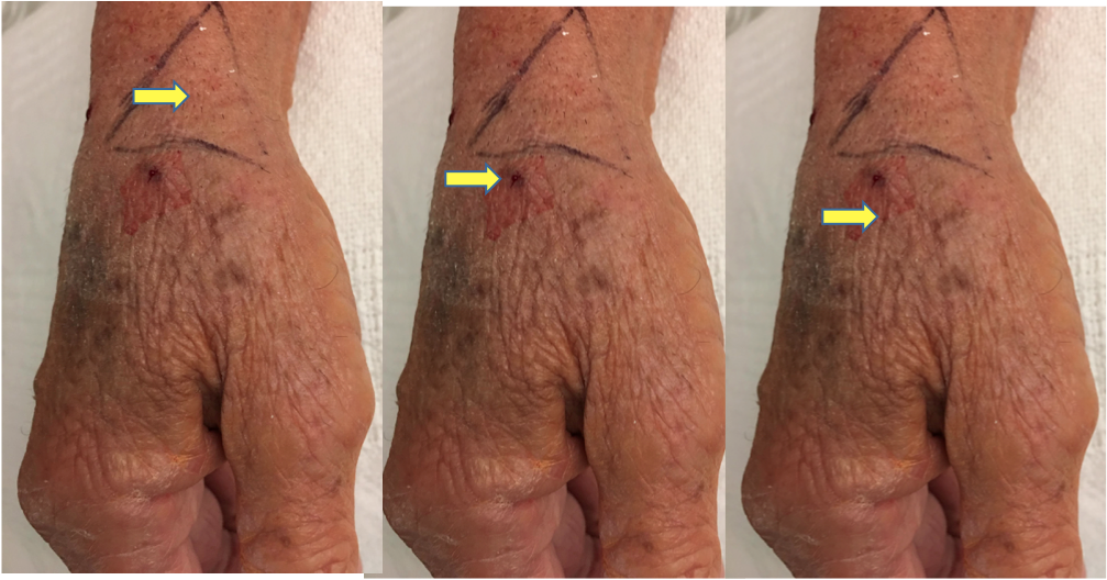 Distal radial access - Figure 3. Ultrasound prior to the procedure helps confirm anatomic landmarks and characterize quality and patency of the target vessel, as well as helps identify secondary puncture options should they become necessary. #radialfirst