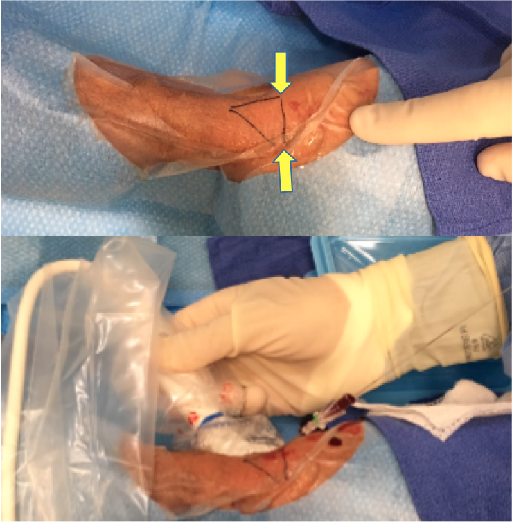 Figure 6. The margins of the anatomical snuffbox are marked with black ink to avoid unintentional puncture outside the distal radial artery’s trajectory. Distal Radial access. #radialfirst