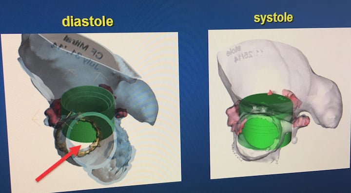 LVOT obstruction when using a Sapien valve in the mitral valve position.