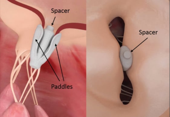 Pascal clip transcatheter mitral valve repair TMVR