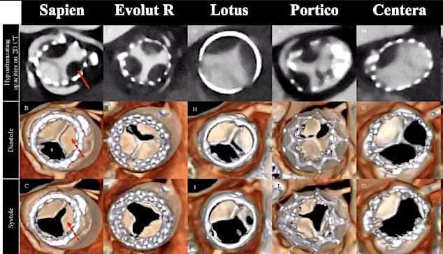 TAVR valve hypo-attenuated leaflet thickening (HALT) seen on CT imaging.