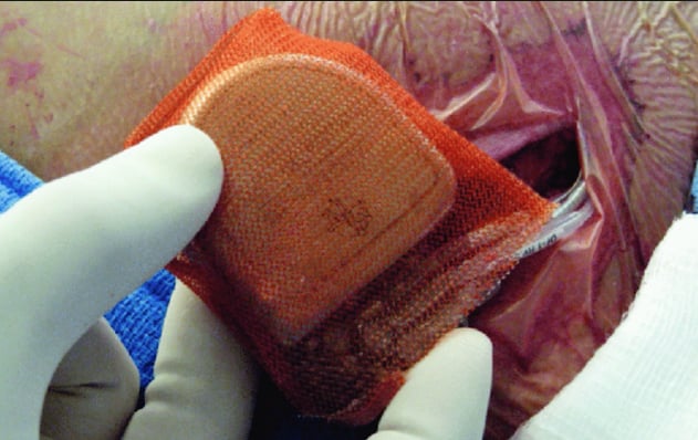 Antibiotic Envelope for Cardiac Implantable Device Infection Prevention