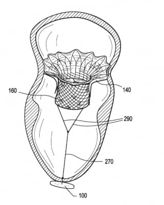 Abbott Tendyne TMVR system received CE mark clearance. This is a U.S. Patent Office illustration showing how the valve uses an anchor  attached to the apex of the heart to keep the valve in the mitral annulus and prevent embolization. The anchor system was used because the mitral valve has a very thin landing zone to secure the valve and this system prevents LVOT obstruction.