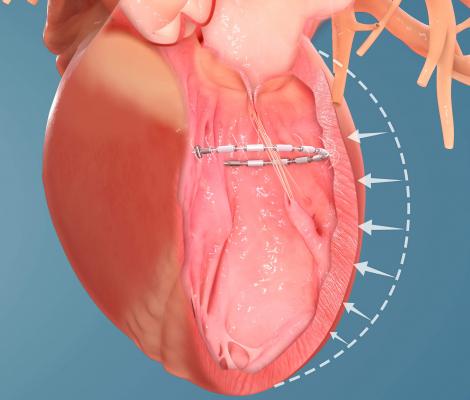 Ancora Heart AccuCinch device to remodel the LV in heart failure patients.