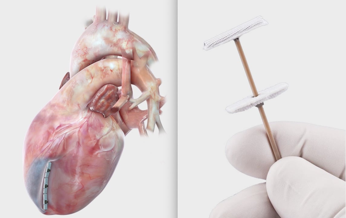 BioVentrix Revivent TC heart failure device.