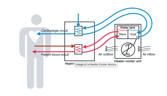 Figure 1: Schematic representation of heater–cooler circuits tested for transmission of Mycobacterium chimaera during cardiac surgery despite an ultraclean air ventilation system. Blue arrows indicate cold water flow, and red arrows indicate hot water flow and patient blood flow.