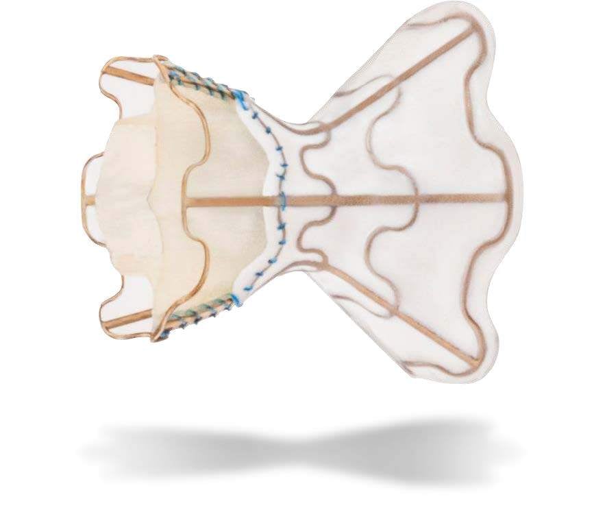 V-Wave intra-atrial shunt to treat heart failure.