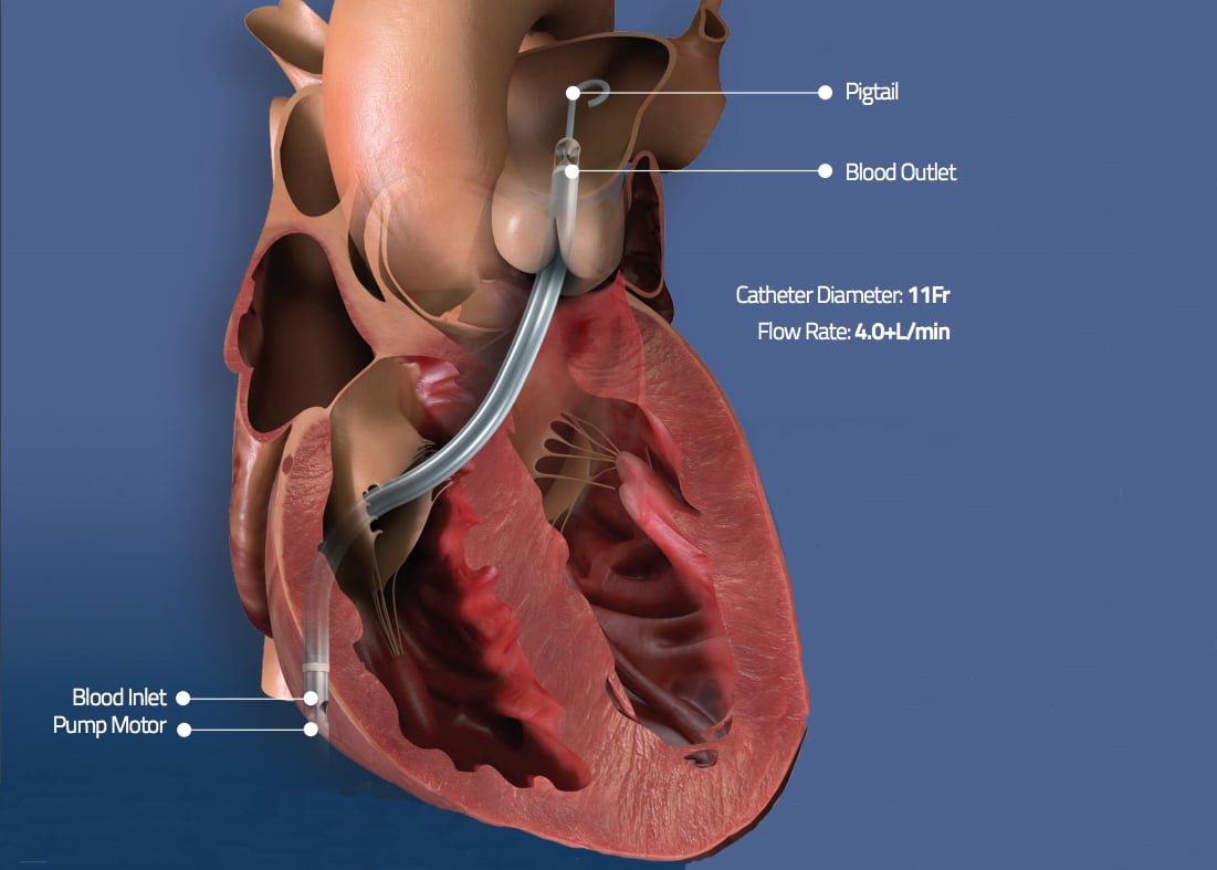 Impella RP is now FDFA cleared for use in COVID-19 patients with right side heart failure or due to pulmonary embolism.
