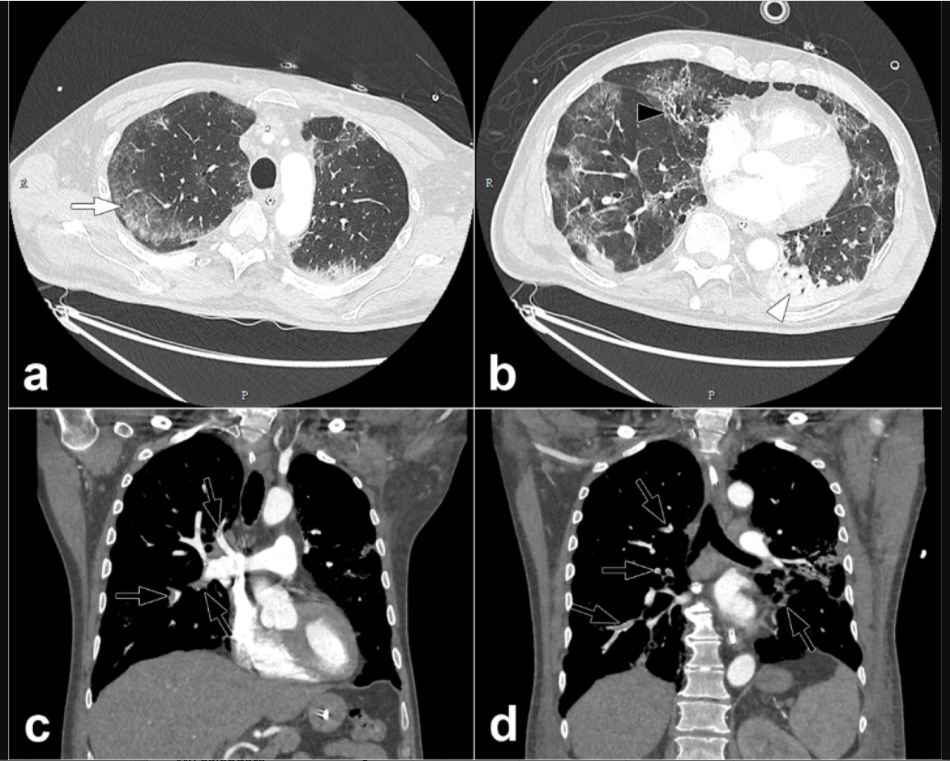 Vascular impact of COVID-19. COVID-19 caused pulmonary embolism (PE) clots on a chest CT from RSNA journal Radiology. #COVID19 #SARSCoV2 #COVIDPE