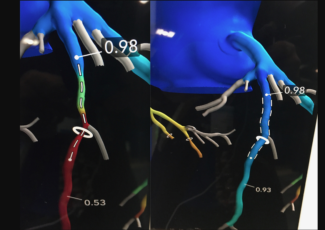 HeartFlow Planner is a non-invasive, real-time virtual modeling tool for coronary artery disease (CAD) intervention. The HeartFlow Planner will enable interventional cardiologists to virtually model clinical scenarios vessel-by-vessel, explore treatment strategies for patients with CAD before each procedure, review cases with colleagues and ensure everyone has a clear picture of the initial treatment plan.